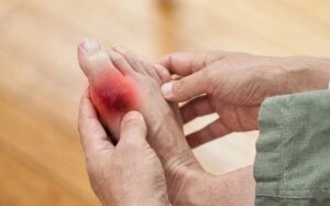 Hallux Rigidus on Big Foot