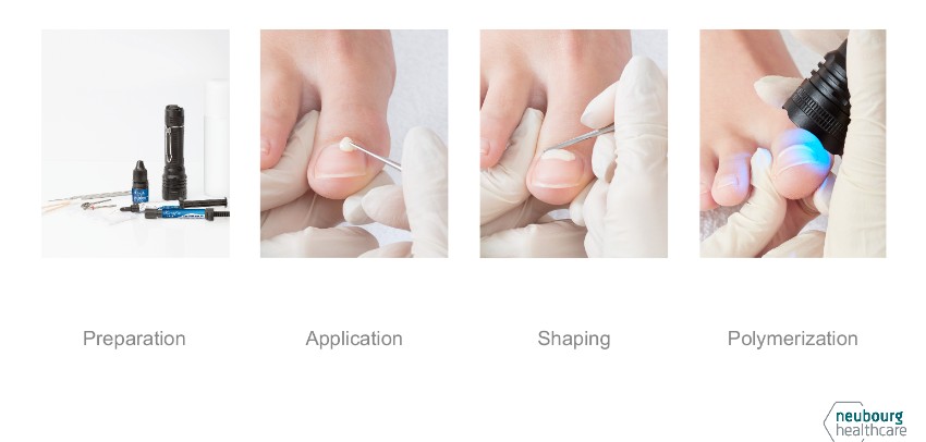 No More Painful Procedures: The Gentle Solution for Ingrown Toenails