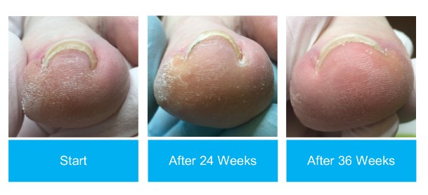 Ingrown Toenail Fixes: Why the Onyfix System Is Better Than Repeated Clipping or Partial Removal